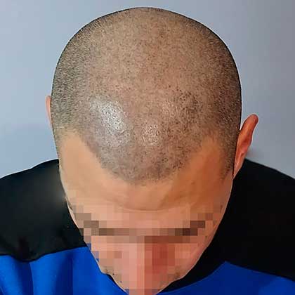 Cabello Después del Tratamiento