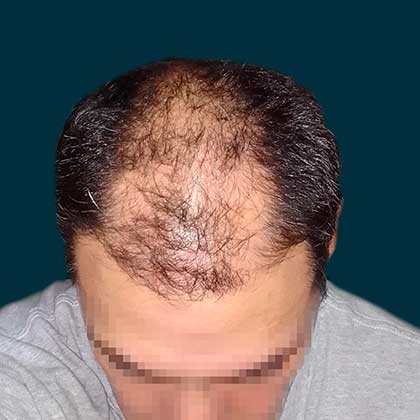 Cabello Previo al Tratamiento